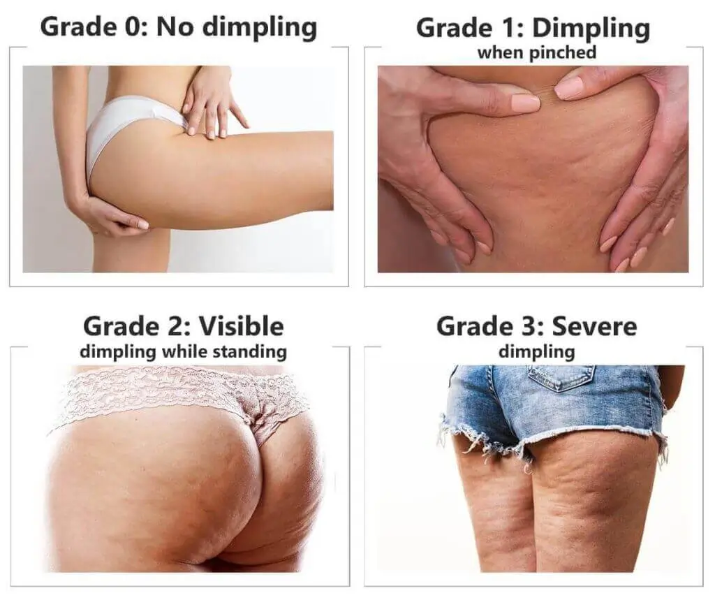 Representation of the stages of cellulite development Bournemouth